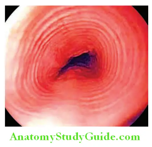 Gastroenterology Endoscopy showing trachealization