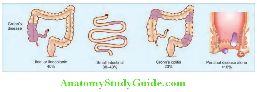Gastroenterology Patterns of distribution in Crohn’s disease