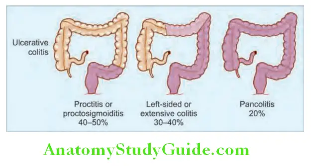 Gastroenterology Patterns of distribution in ulcerative colitis