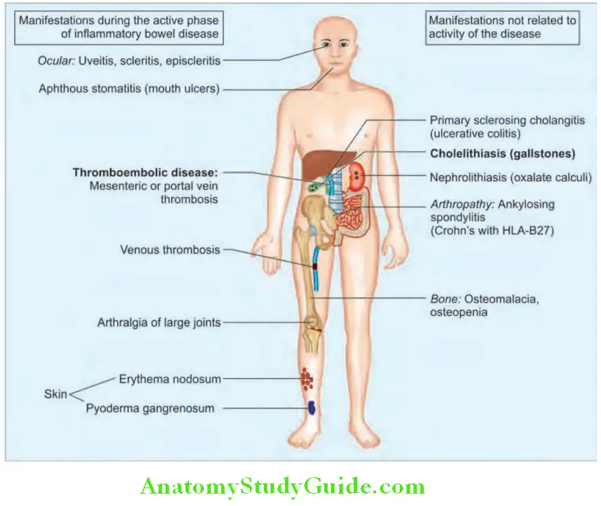 Gastroenterology Systemic complications of inflmmatory bowel disease
