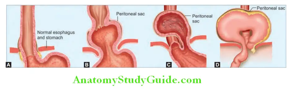 Gastroenterology Types of hiatus hernia