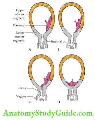 General embryology Types of placenta previa