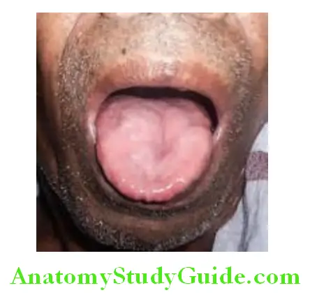 Hematology Atrophic glossitis producing bald tongue in iron defiiency anemia