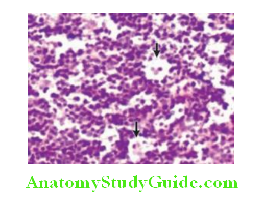 Hematology Burkitt lymphoma composed of medium sized lymphoid cells admixed with benign macrophages arrows giving a starry sky appearance