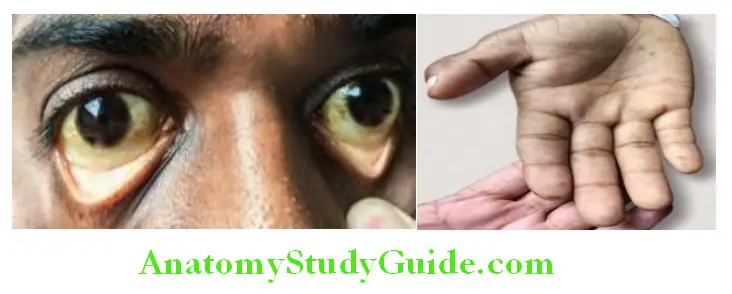 Hematology Pallor of palpebral conjunctiva and Pale palms with pale creases