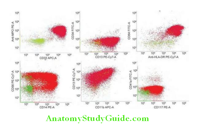 Hematology Pattern seen in AML