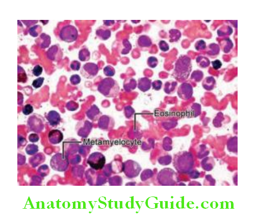 Hematology Peripheral blood picture in chronic stable phase of chronic myeloid leukemia