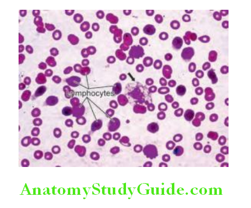 Hematology Peripheral blood smear in chronic lymphocytic leukemia showing numerous small lymphocytes and few smudge cells arrow