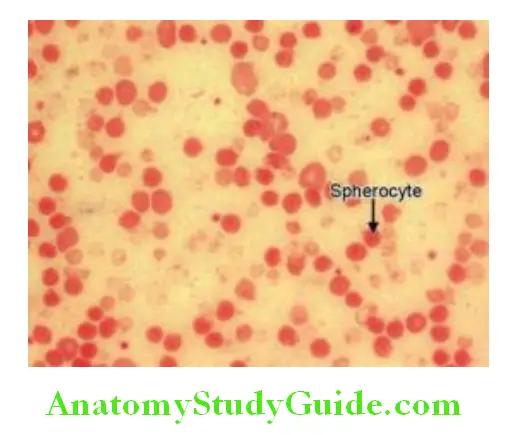 Hematology Peripheral blood smear with numerous spherocytes arrow in hereditary spherocytosis