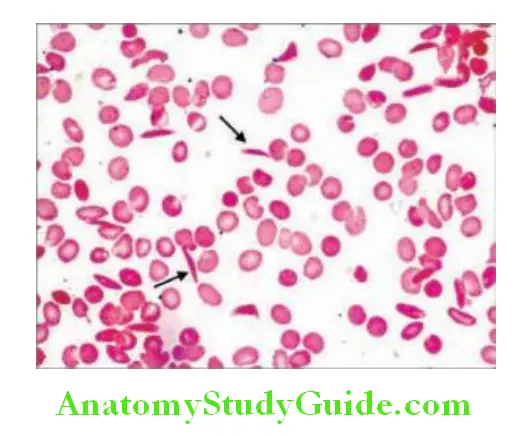 Hematology Peripheral blood smear with sickle cells arrows