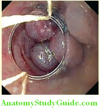 Hepatobiliary System Banding of esophageal varices