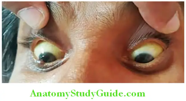 Hepatobiliary System Conjunctiva showing mild jaundice in hemolytic anemia