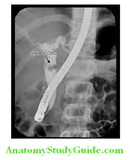 Hepatobiliary System ERCP shows stone in the common bile duct