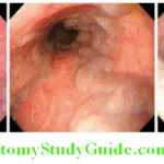 Hepatobiliary System Endoscopy view of esophageal varices