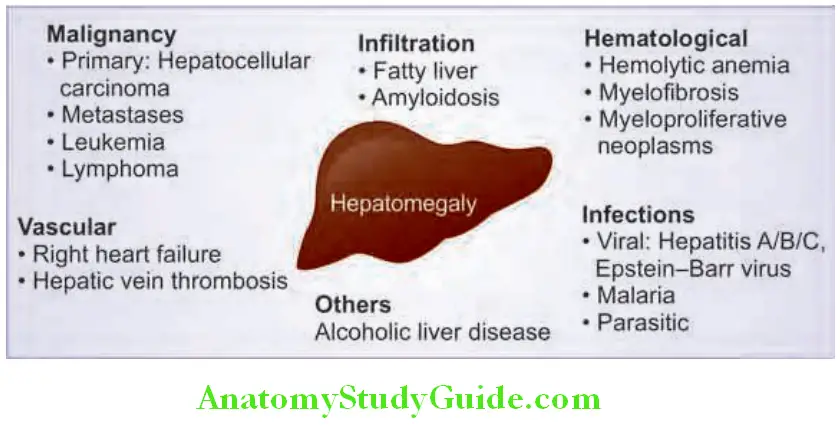 Hepatobiliary System Hepatomegaly according to underlying pathology