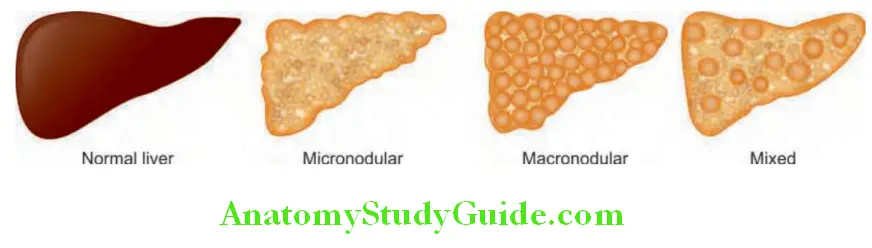 Hepatobiliary System Morphological classifiation of cirrhosis