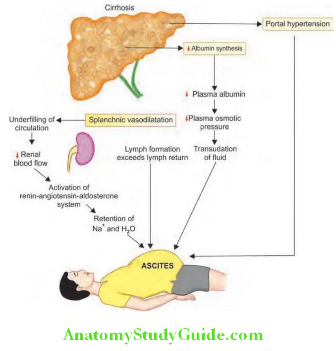 Hepatobiliary System Pathogenesis of ascites in cirrhosis