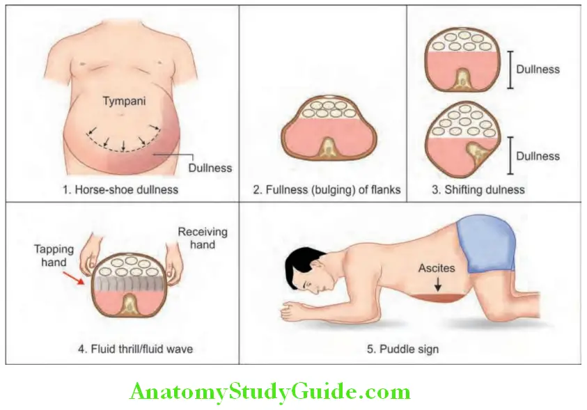 Hepatobiliary System Signs of ascites