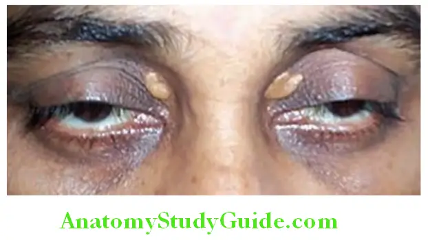 Hepatobiliary System Xanthelasmas around the eyes