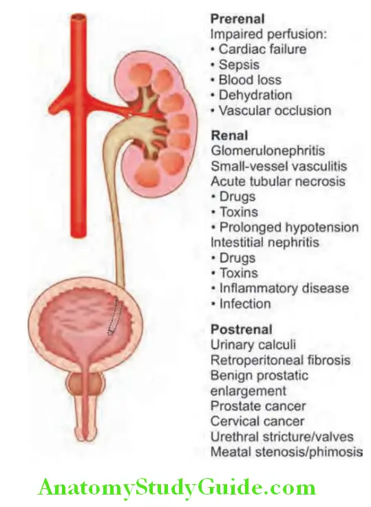 Kidney Causes of acute kidney injury