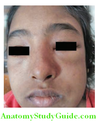 Kidney Facial and periorbital puffiss in nephrotic syndrome