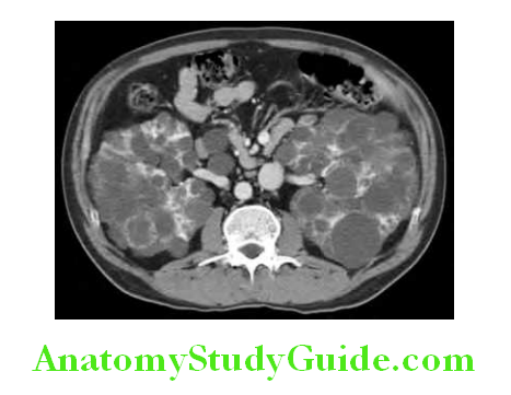 Kidney MRI showing polycystic kidney