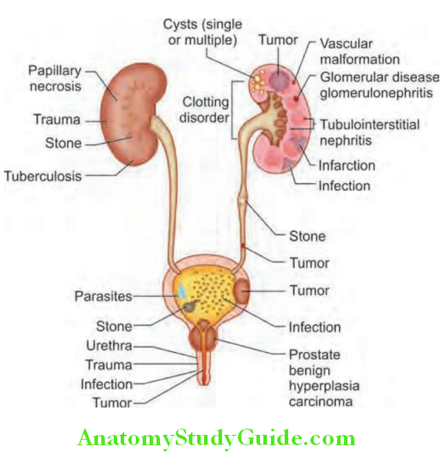 Kidney Morphological changes in reflx nephropathy compared with normal