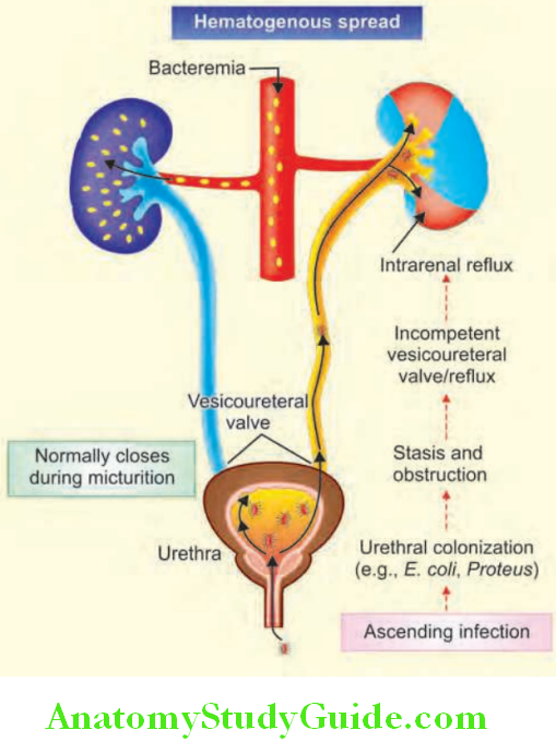 Kidney Pathogenesis of acute pyelonephritis. More common mode is ascending infection