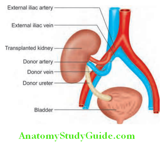 Kidney Renal transplantation