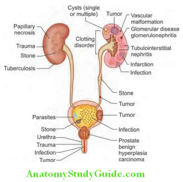 Kidney Sites and common causes of bleeding from the urinary tract