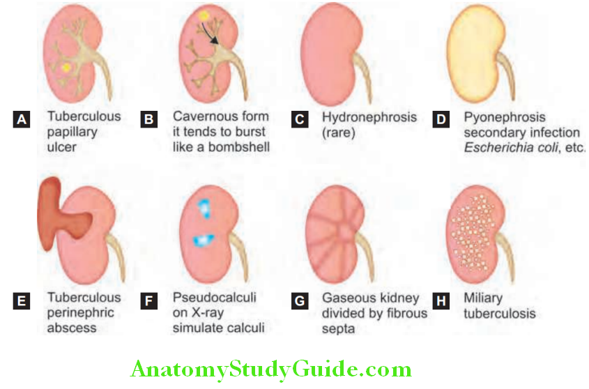 Kidney Various types of lesions in tuberculosis of kidney