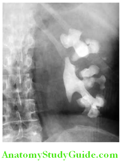 Kidney X-ray shows staghorn calculi