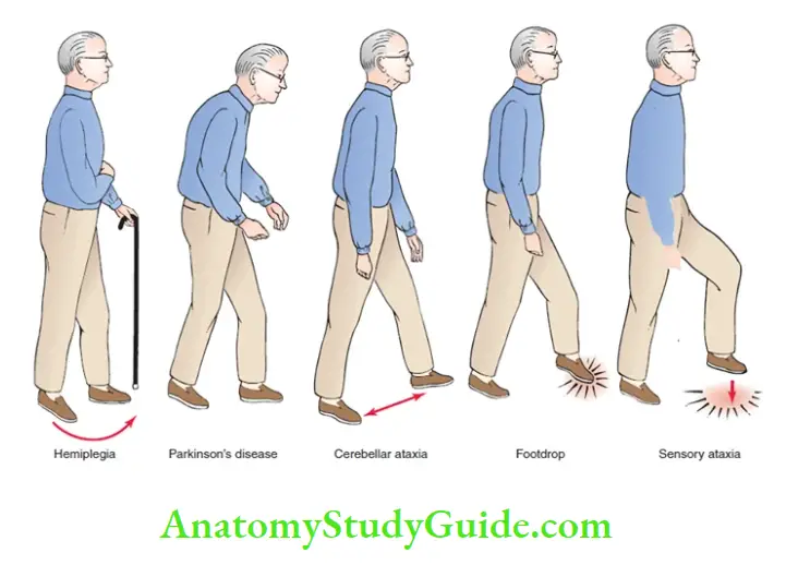 Neurology Abnormal gait.