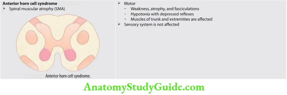 Neurology Anterior horn cell syndrome