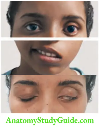 Neurology Bell’s palsy (A) with Bell’s phenomenon (B).