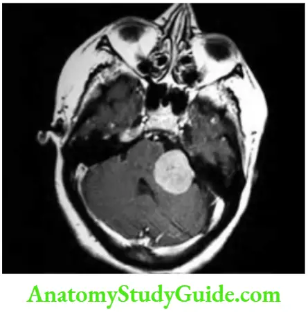 Neurology CT showing cerebellopontine angle tumor.
