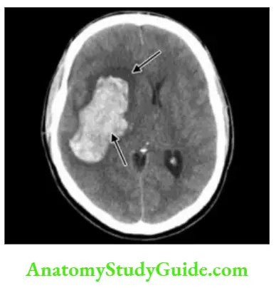 Neurology CT showing hemorrhage in internal capsule.