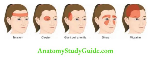 Neurology Common primary headaches—characteristic features.