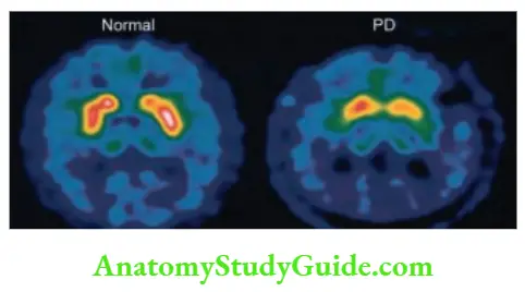 Neurology Dopamine transporter (DaT) imaging.