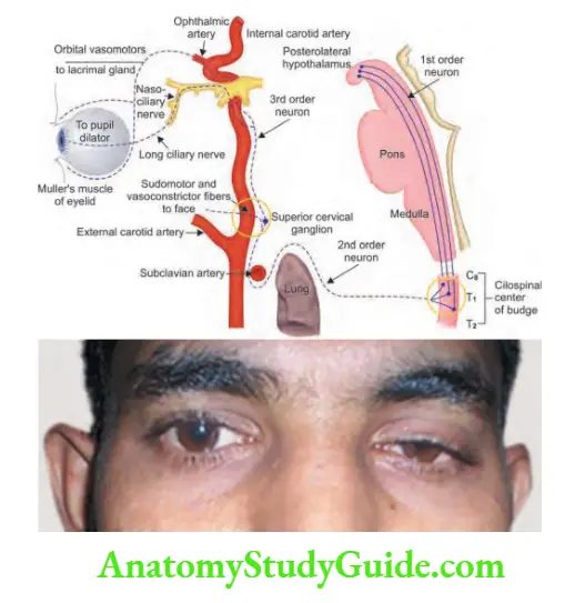 Neurology Left Horner’s syndrome.