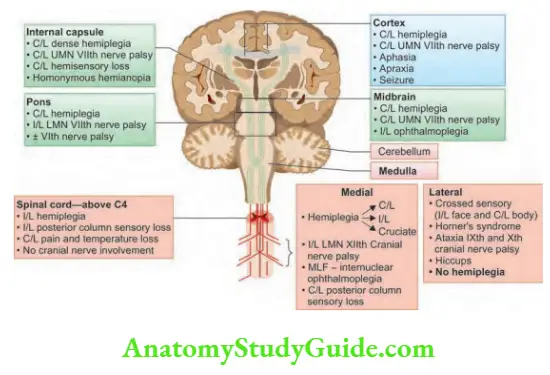 Neurology Localization of lesion in hemiplegia.