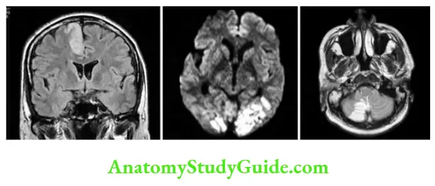 Neurology Neuroimaging in stroke