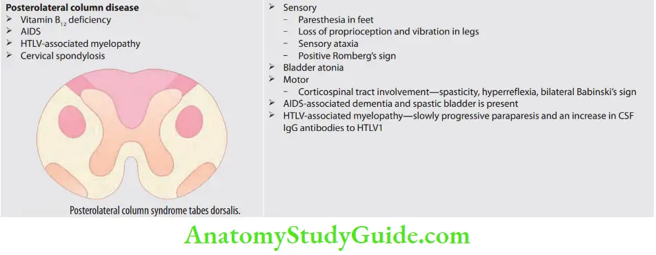 Neurology Posterolateral column syndrome tabes dorsalis