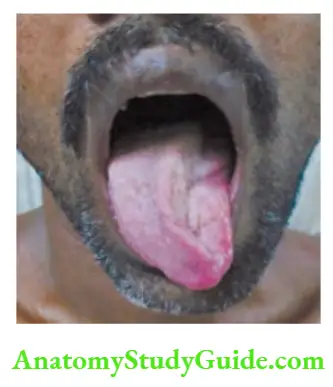 Neurology Tongue wasting with atrophy.