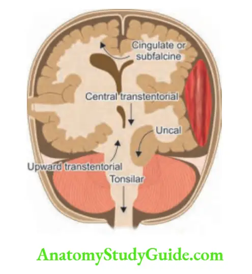 Neurology Types of herniation.