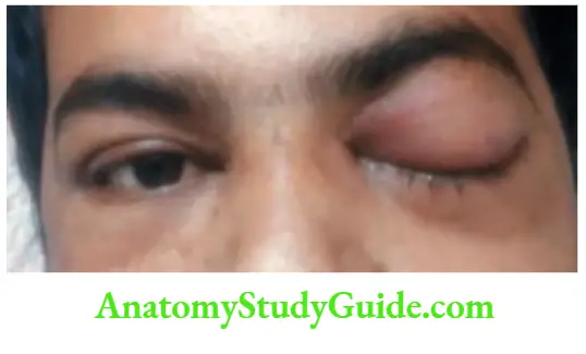 Neurology Unilateral ptosis.