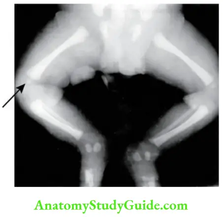 Osteology Radiograph showing ossification at the lower end of femur