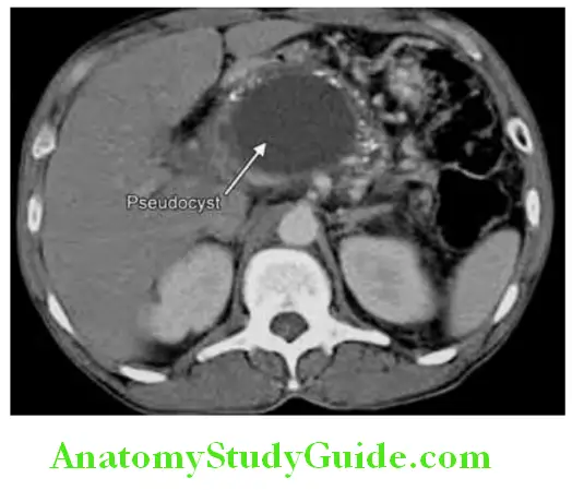 Pancreas CT image showing pseudocyst