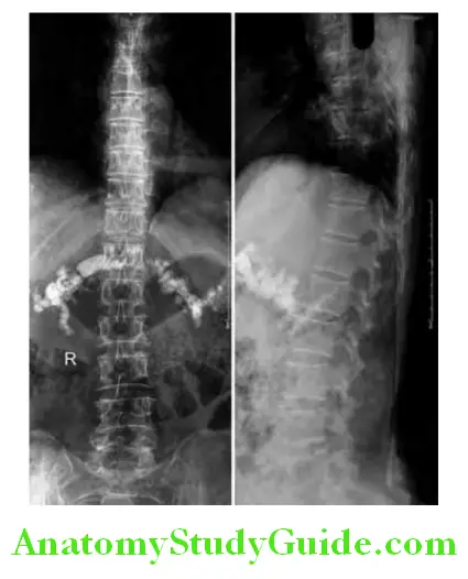 Pancreas Erect abdominal X-ray AP and lateral views showing calcifi pancreatitis