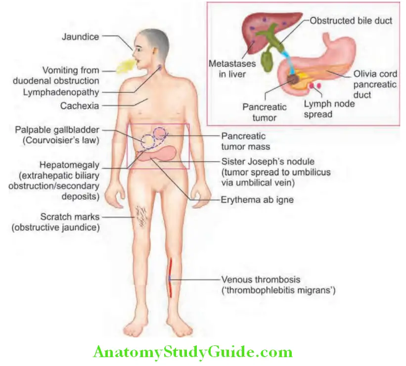 Pancreas Features of carcinoma of the pancreas